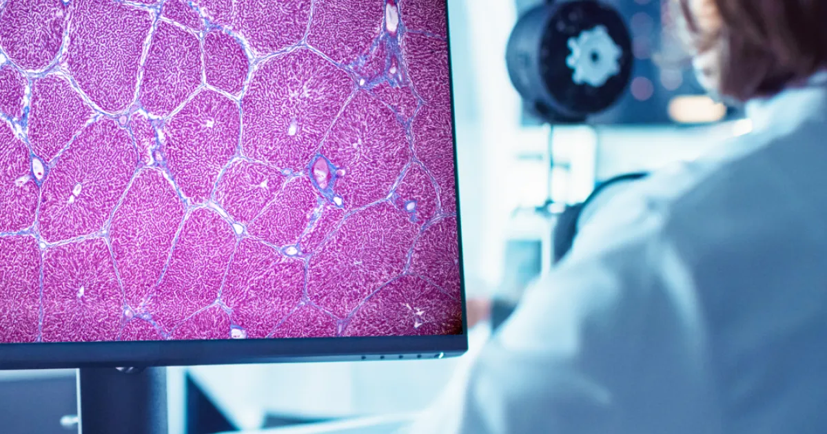 EMA qualifies first artificial intelligence tool to diagnose inflammatory liver disease (MASH) in biopsy samples